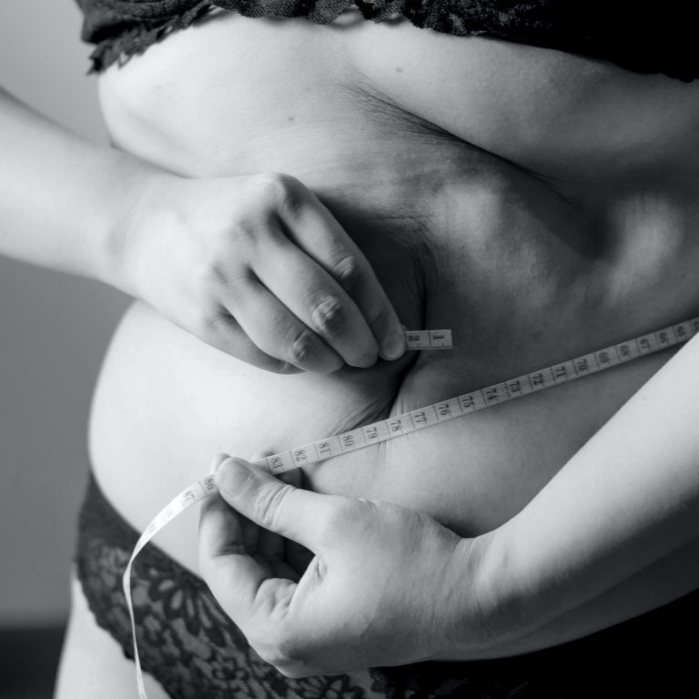 liposuccion et perte de poids