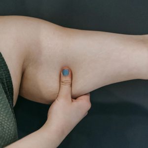 problème peau sous les bras lifting